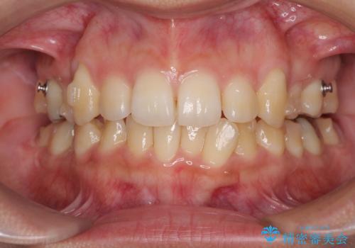 八重歯の抜歯矯正 補助装置を用いたインビザライン矯正の治療中