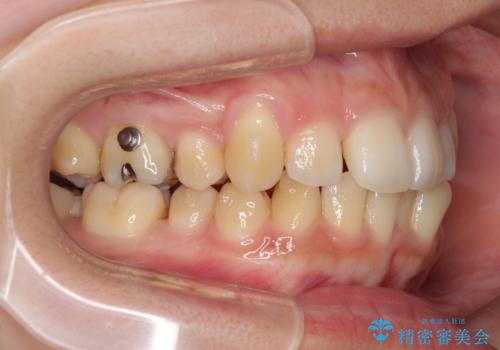 八重歯の抜歯矯正　補助装置を用いたインビザライン矯正の治療中