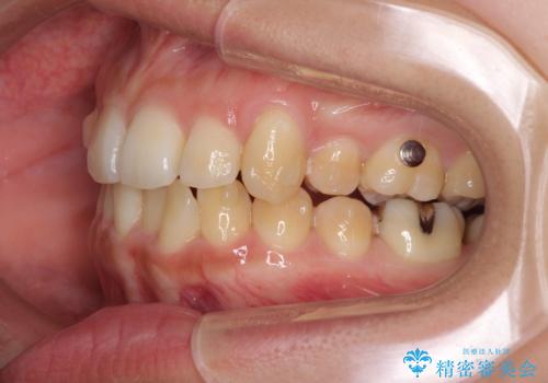 八重歯の抜歯矯正 補助装置を用いたインビザライン矯正の治療中