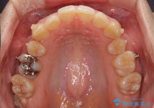 八重歯の抜歯矯正 補助装置を用いたインビザライン矯正の治療中