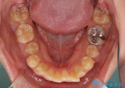 八重歯の抜歯矯正 補助装置を用いたインビザライン矯正の治療中