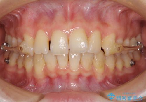 インビザラインによる矯正治療　カリエールディスタライザーを用いた奥歯の咬み合わせ改善の治療中