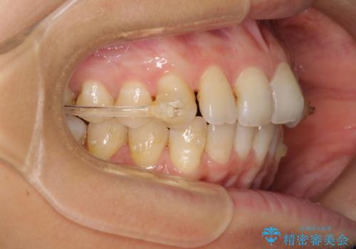 インビザラインによる矯正治療　カリエールディスタライザーを用いた奥歯の咬み合わせ改善の治療中