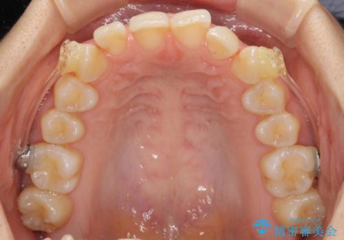 インビザラインによる矯正治療 カリエールディスタライザーを用いた奥歯の咬み合わせ改善の治療中