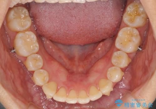 インビザラインによる矯正治療 カリエールディスタライザーを用いた奥歯の咬み合わせ改善の治療中