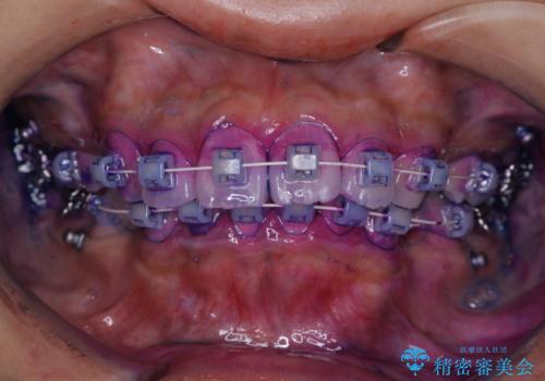 ワイヤー矯正を初めてから2カ月 歯磨き指導とPMTCの治療前