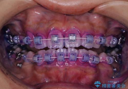 ワイヤー矯正を初めてから2カ月　歯磨き指導とPMTC
