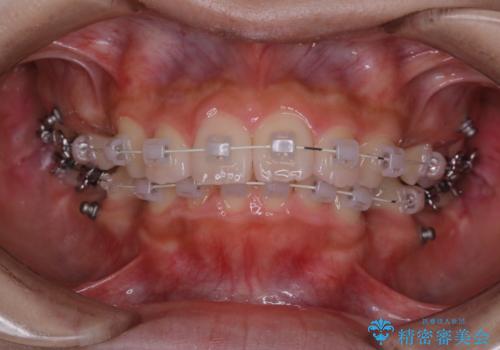 ワイヤー矯正を初めてから2カ月 歯磨き指導とPMTCの治療後