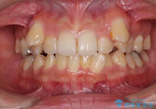 八重歯の抜歯矯正　補助装置を用いたインビザライン矯正の治療前