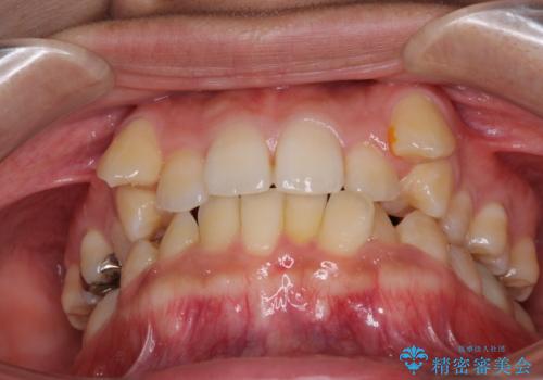 八重歯の抜歯矯正 補助装置を用いたインビザライン矯正の治療前