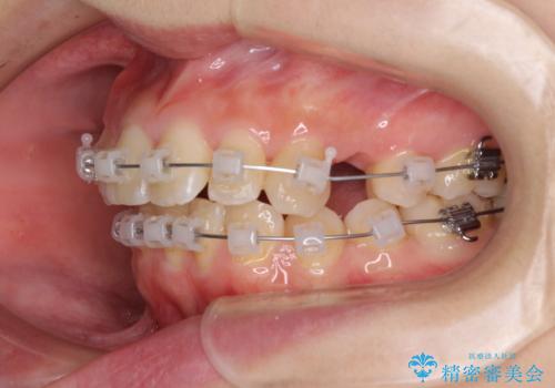 前歯2本が欠損　抜歯矯正でデコボコを治すの治療中