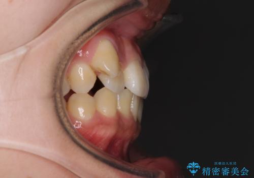 八重歯の抜歯矯正 補助装置を用いたインビザライン矯正の治療前