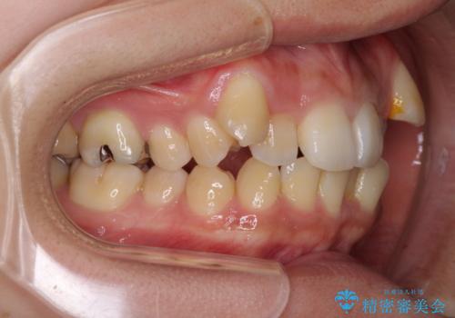八重歯の抜歯矯正 補助装置を用いたインビザライン矯正の治療前