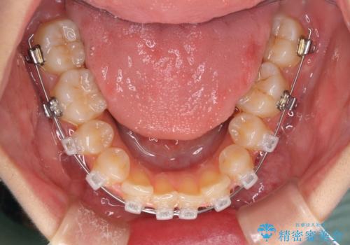 前歯2本が欠損 抜歯矯正でデコボコを治すの治療中