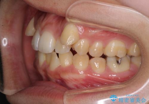 八重歯の抜歯矯正 補助装置を用いたインビザライン矯正の治療前