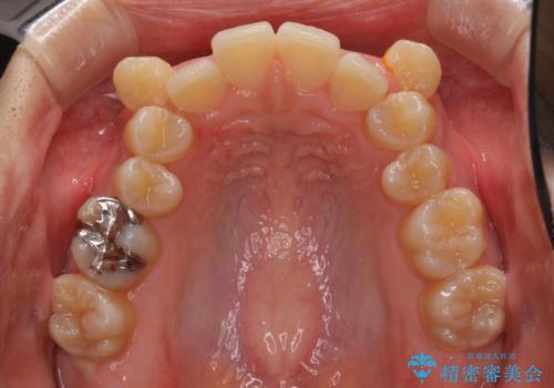 八重歯の抜歯矯正　補助装置を用いたインビザライン矯正の治療前