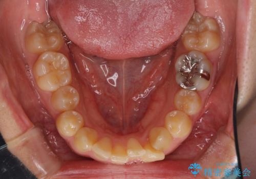 八重歯の抜歯矯正 補助装置を用いたインビザライン矯正の治療前
