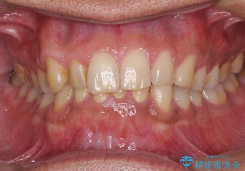 強い咬み合わせで削れた前歯 セラミッククラウンで自然な形にの治療後