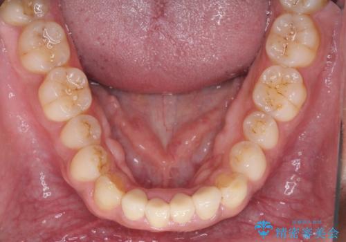 強い咬み合わせで削れた前歯 セラミッククラウンで自然な形にの治療後