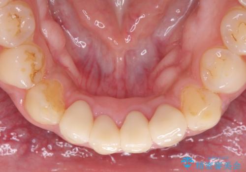 強い咬み合わせで削れた前歯 セラミッククラウンで自然な形にの治療後
