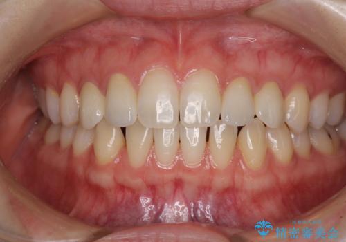 前歯の奇形歯 オールセラミッククラウンによる審美歯科治療の治療後