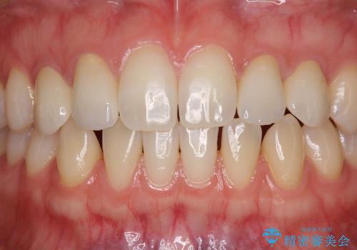 前歯の奇形歯　オールセラミッククラウンによる審美歯科治療