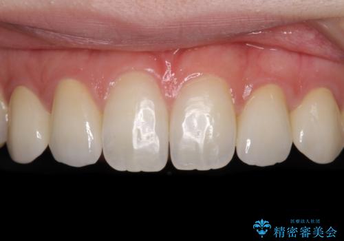前歯の奇形歯　オールセラミッククラウンによる審美歯科治療の治療後