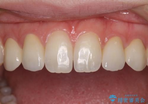 前歯の奇形歯　オールセラミッククラウンによる審美歯科治療の治療後