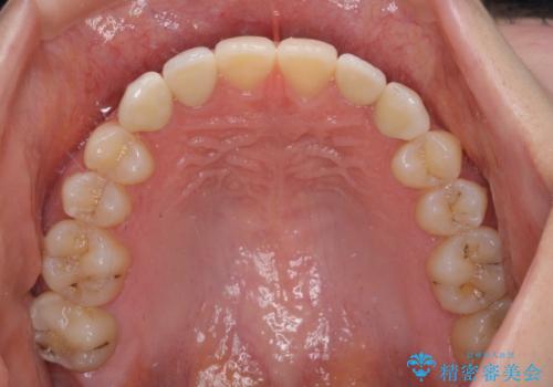 前歯の奇形歯 オールセラミッククラウンによる審美歯科治療の治療後