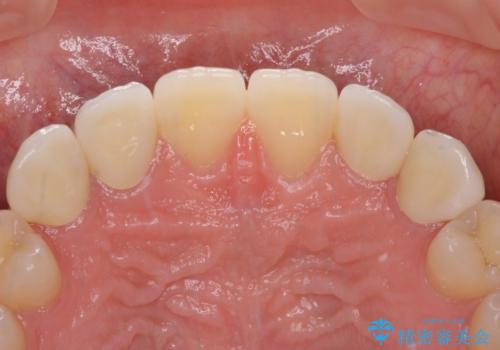 前歯の奇形歯 オールセラミッククラウンによる審美歯科治療の治療後