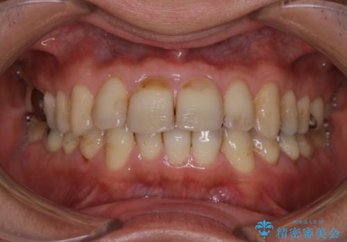 虫歯の治療を始める前にPMTCできれいにの治療前