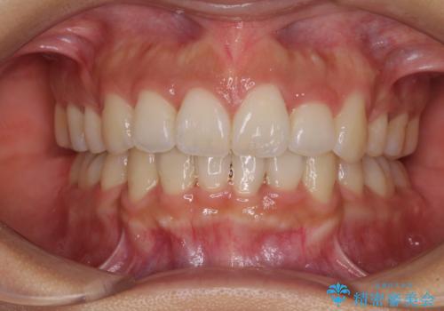 スッキリとした口元へ 出っ歯の抜歯矯正