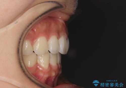 スッキリとした口元へ 出っ歯の抜歯矯正の治療後