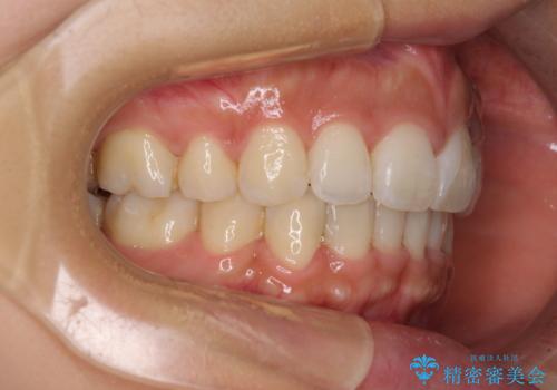スッキリとした口元へ　出っ歯の抜歯矯正の治療後