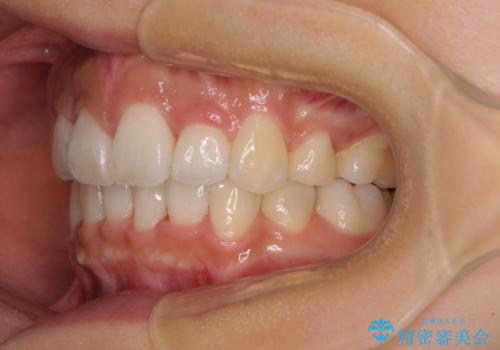 スッキリとした口元へ 出っ歯の抜歯矯正の治療後