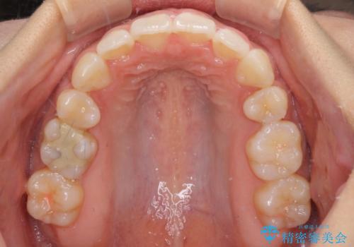 スッキリとした口元へ 出っ歯の抜歯矯正の治療後