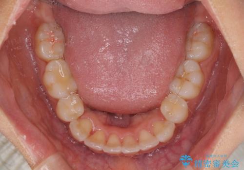 スッキリとした口元へ 出っ歯の抜歯矯正の治療後