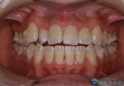 インビザライン矯正治療中にPMTCでお口の中を清潔にの治療前