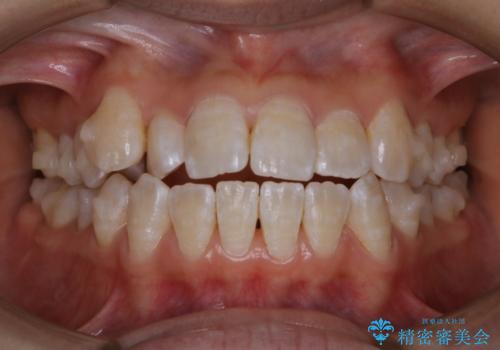 インビザライン矯正治療中にPMTCでお口の中を清潔にの治療後