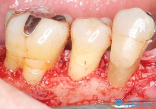 骨を再生させて歯周病を治す　再生療法　50代男性の治療中
