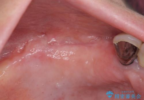 上顎奥歯の欠損をインプラントで補綴治療の症例 治療前