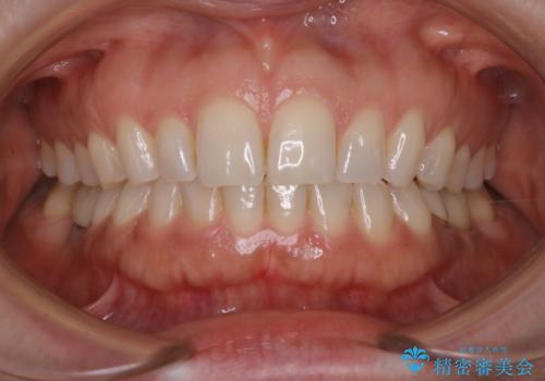 ワインによる黄ばみをPMTCできれいに除去の治療前