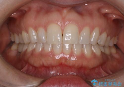 ワインによる黄ばみをPMTCできれいに除去の治療後