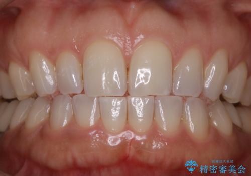 ワインによる黄ばみをPMTCできれいに除去の症例 治療後