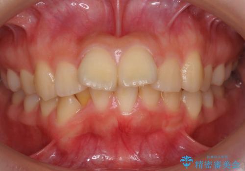 20代女性 出っ歯 口元を引っ込めたいの症例 治療前