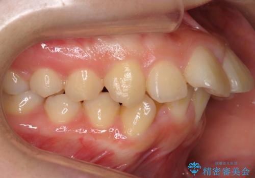 20代女性 出っ歯 口元を引っ込めたいの治療前