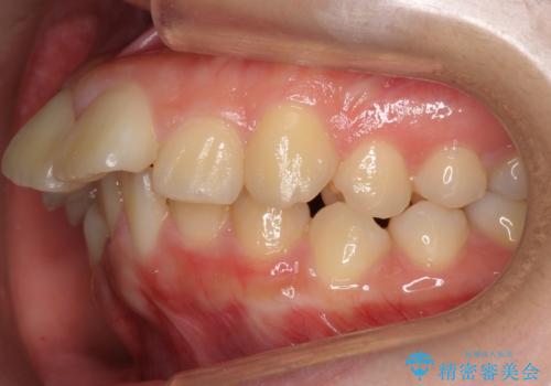 20代女性 出っ歯 口元を引っ込めたいの治療前