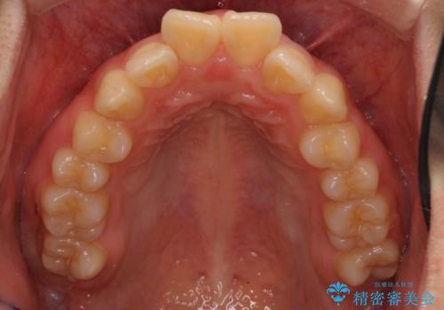 20代女性 出っ歯 口元を引っ込めたいの治療前