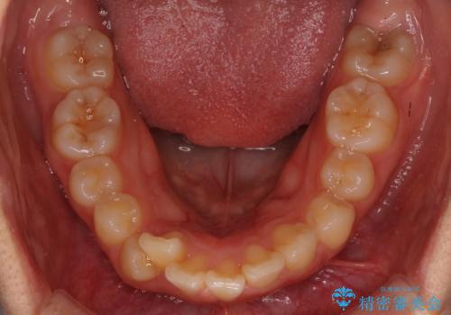 20代女性 出っ歯 口元を引っ込めたいの治療前
