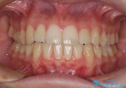 気になる前歯を整えたい インビザライン・ライトでの矯正治療の治療中